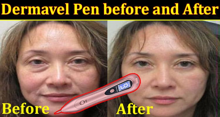 Latest News Dermavel Pen Before And After