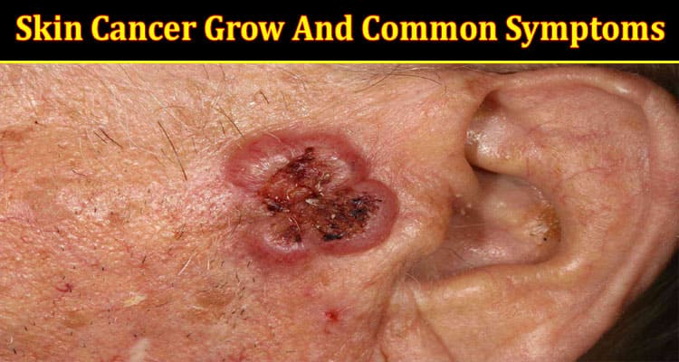How Fast Does Skin Cancer Grow And Common Symptoms On Body