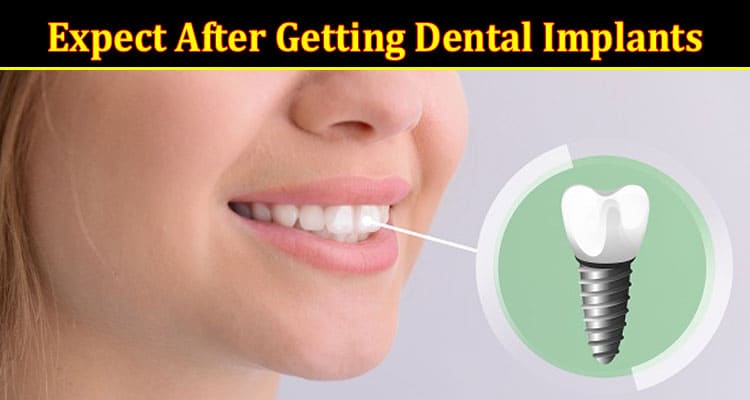 Complete Information About What to Expect After Getting Dental Implants - Recovery and Care Tips